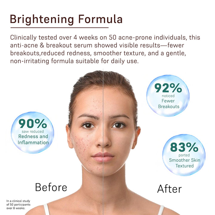 Anti-Acne & Breakouts Face Serum